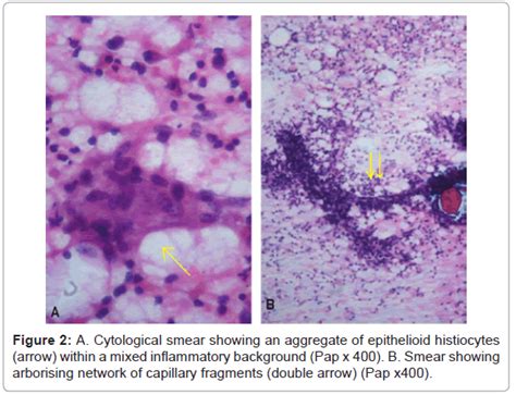 Cytology Histology Cytological Aggregate