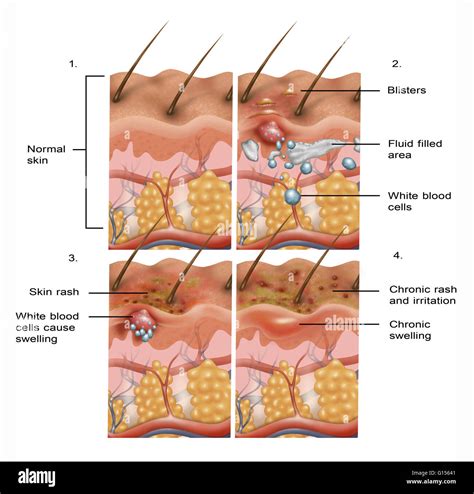 Eczema Herpeticum Stages At Bruce Schmidt Blog