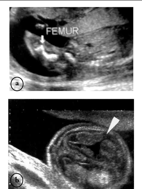 Figure 1 From Second Trimester Diagnosis Of Osteogenesis Imperfecta Associated With