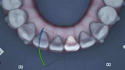 Top 3 Clear Aligner Therapy Overcorrections And Overtreatments Invisalign