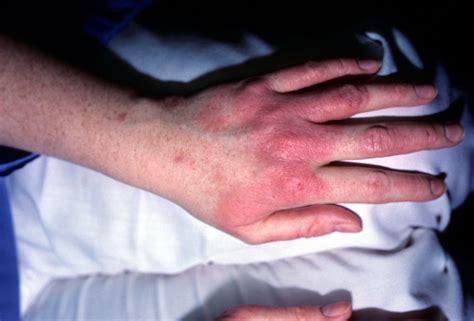 Your Guide To A Latex Condom Allergy Causes Symptoms Treatment And