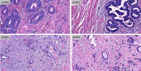 Representative H E Images Of Bd Bd Bd And Bd Tumor