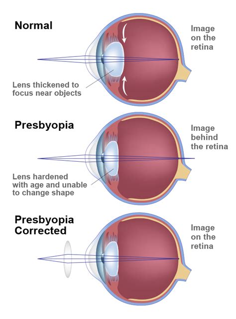 Presbyopia Toronto On Tlc Laser Eye Centers