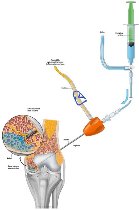 Illustration By Mark Miller For A Local Orthopedic Surgeon For Print