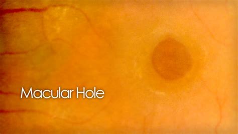 Macular hole - a patient's guide of causes and treatments