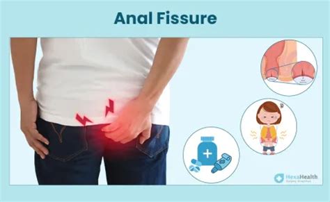 Anal Fissure Symptoms Causes Images Surgery More