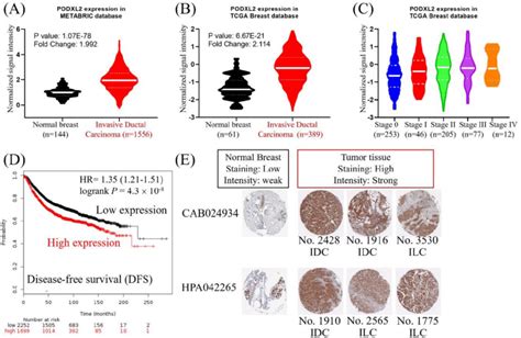 High Expression Of PODXL2 Was Associated With Poor Prognoses Of