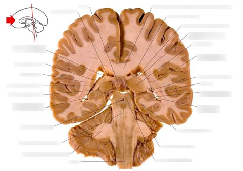 Coronal Cut Of Brain Slide 7 Diagram Quizlet