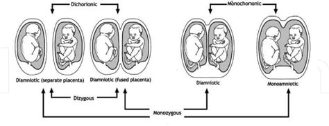 Figure 3 From Monochorionic Twin Pregnancy— Potential Risks And