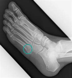 5th Metatarsal Fracture Surgery Procedure & Recovery