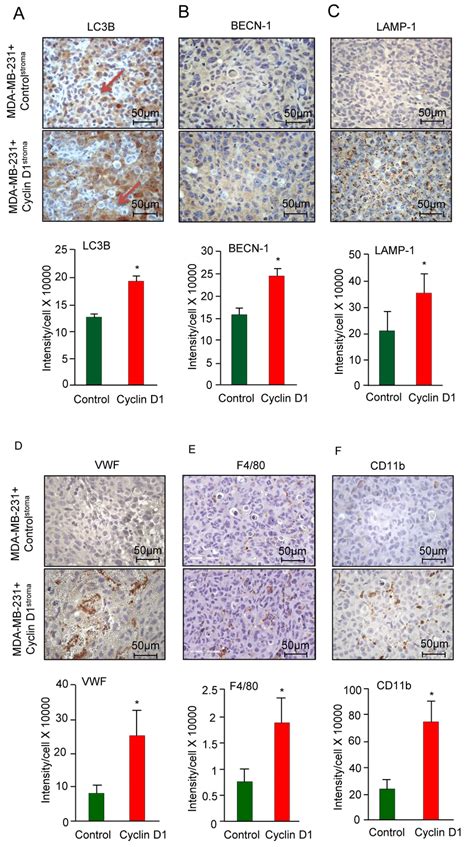 Cyclin D1 Stroma Expression Increases Breast Cancer Inflammation A