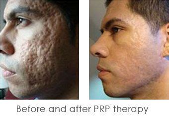 Prp Treatment For Face Lucas Mackay