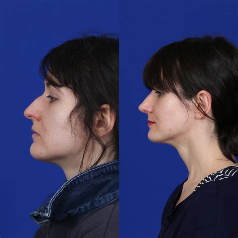 Before And After Female Primary Rhinoplasty Facial Plastic Surgeon