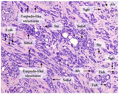 Invasive Breast Carcinoma Of No Special Type The Invasive Component Of