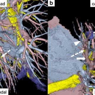 Preoperative Computed Tomography Ct Revealed A Mm Diameter Solid