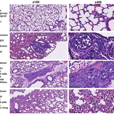 CSE Knockdown Inhibits Human Breast Cancer Metastasis In Nude Mice