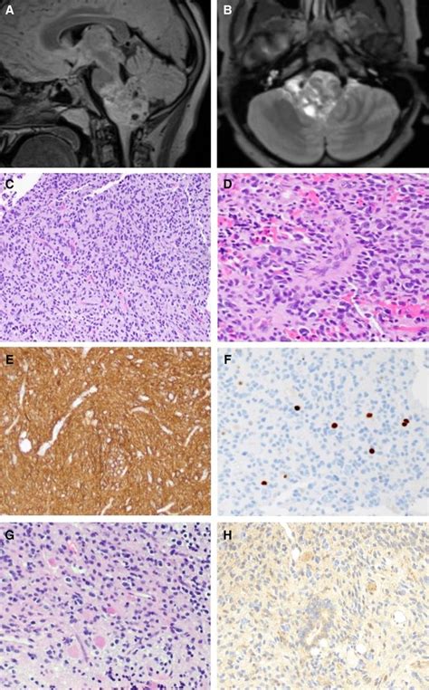 Diffuse Midline Glioma With Novel Potentially Targetable Fgfr2vps35