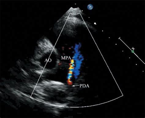 Patent Ductus Arteriosus And Aortopulmonary Window Thoracic Key