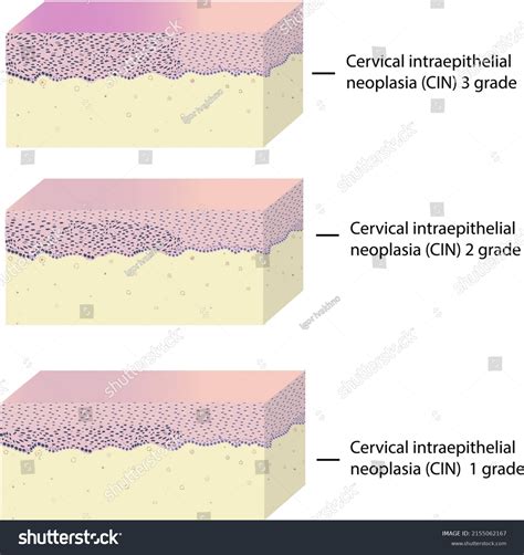 Histology Of Intraepithelial Neoplasia Of Cervix Royalty Free Stock Vector 2155062167