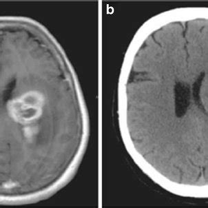 Illustrative Case Of A Patient Of Group With Left Frontal Gbm On