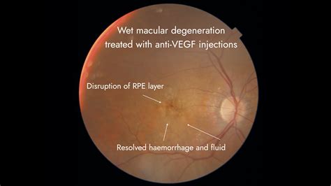 Anti Vegf Intravitreal Injection