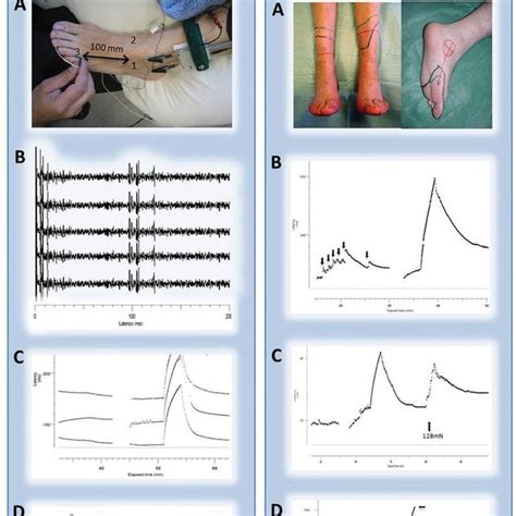 Symptoms Of Erythromelalgia The Left Foot Of Patient 1 During An