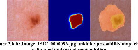 Pdf Isic 2017 Skin Lesion Analysis Towards Melanoma Detection