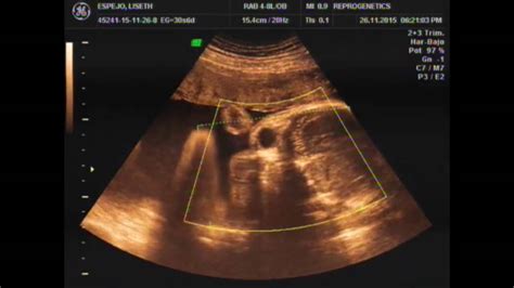 Ecografia Impresionante 4D HD Embarazo De 7 MESES Bebe Moviendose Y