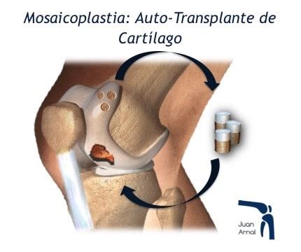 Cirugia De Cartilago De Rodilla Dara Torres