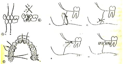 gay xuong ham Răng hàm mặt