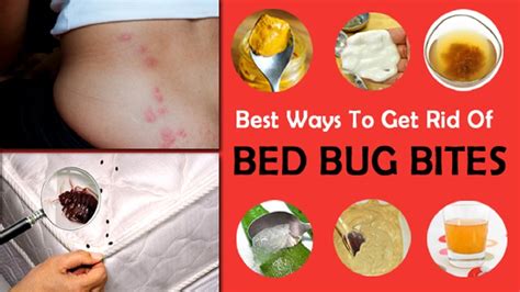 How To Treat Bed Bug Rash | wasaga beach break fast ca