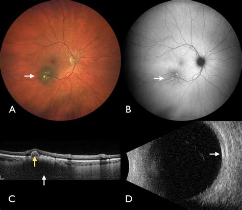 Choroidal Nevus With Lipofuscin