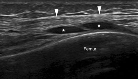 Iliotibial Band Syndrome Runners Knee” Complete Physio