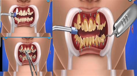 Asmr Satisfying Symbios Socket Preservation Teeth Cavity Treatment Animation Brainasmr136