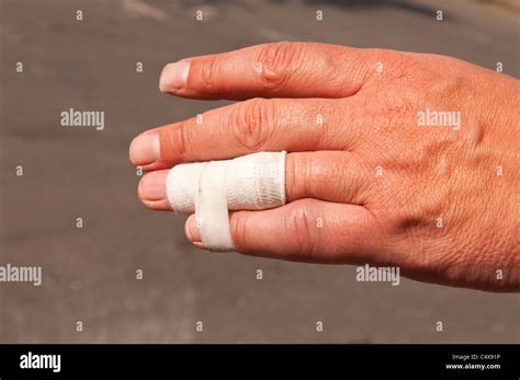 Dislocated Finger Stock Photos And Dislocated Finger Stock Images Alamy