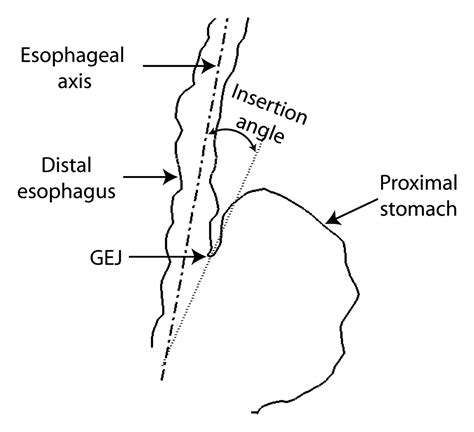 z line irregularity in esophagus 4