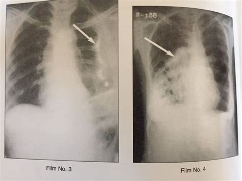 xrays  pleural calcification