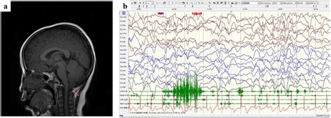 Brain Magnetic Resonance Imaging MRI And Electroencephalogram EEG