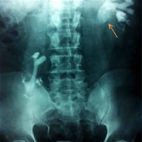 Ultrasound of the left kidney. Hypoechoic irregular mass is noted in... | Download Scientific ...