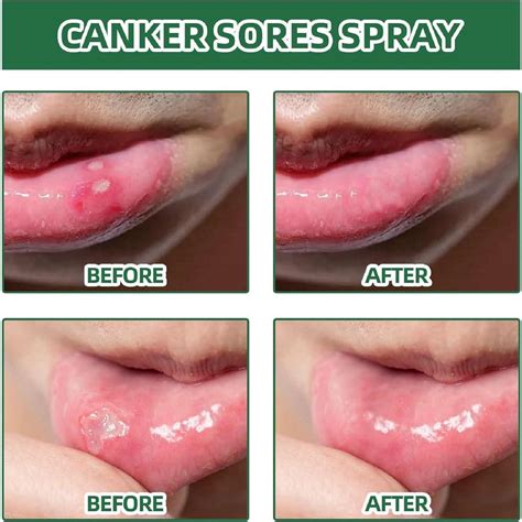 Mouth Ulcer Treatment Spray Mouth Ulcer Spray Mouth Ulcer Relief Spray ...