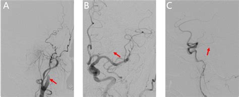 features   emergency digital subtraction angiography dsa