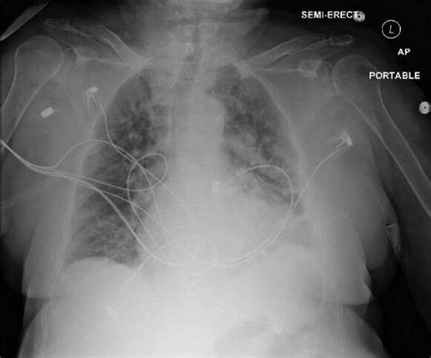 Pulmonary Congestion Chest X Ray