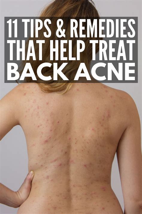 How To Get Rid Of Back Acne 11 Tips And Remedies That Work Back Acne Remedies Acne Remedies