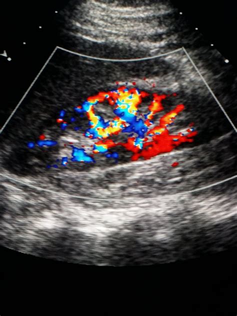 #Doppler #ultrasound. On this ultrasound, the color shows #blood flow