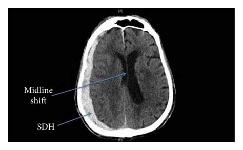 Right Holohemispheric Subdural Hematoma Sdh And Midline Shift In A