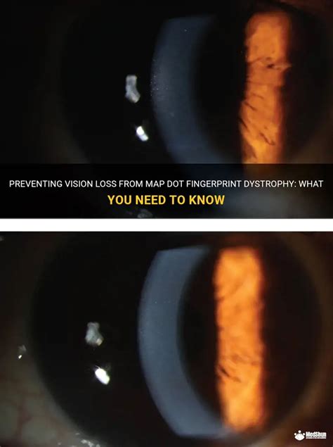 Preventing Vision Loss From Map Dot Fingerprint Dystrophy What You
