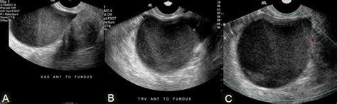 Figure 7 From Sonographic Features Of Tubo Ovarian Abscess Mimicking An