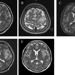 Preoperative Axial T2 Weighted MRI Showing A High Intensity Area With