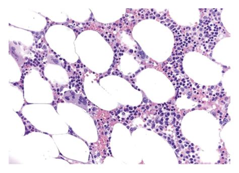 Biopsy Shows Normocellular Bone Marrow For Age ∼30 40 With Trilineage