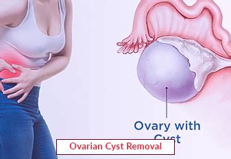 Ovarian Cyst Removal - Diagnosis, Treatment | EdhaCare